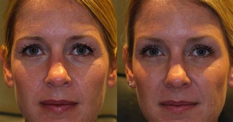 Denver - BOTOX Brow Lift - Photos Show Results Without Surgery