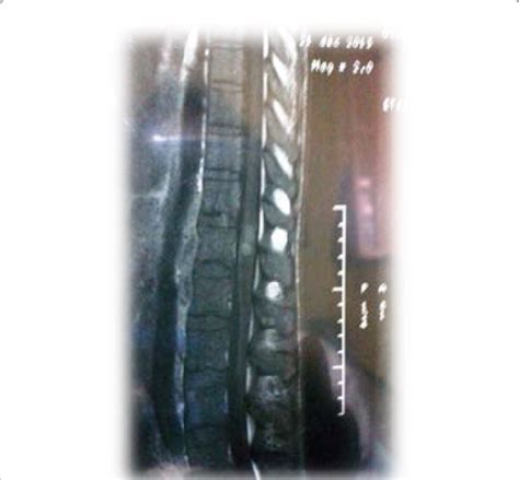 Mri of spinal cord: sagittal section showing 2 well defined lesions. | Download Scientific Diagram