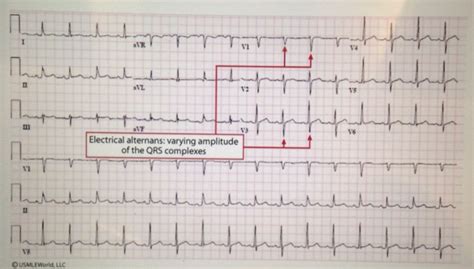 Pin on Pericardial Effusion & Pulmonary Parenchymal