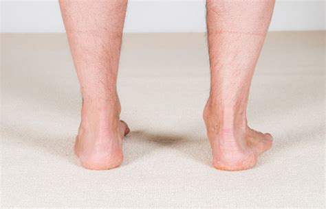 Flat Feet And Overpronation – Difference And Relationship - Straignt Feet