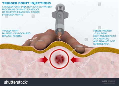 Trigger Point Injection Outpatient Procedure Designed Stock Illustration 1070684189 | Shutterstock