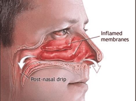 Nasal Congestion | GNO Snoring & Sinus