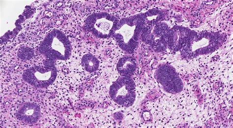 Endometrial serous intraepithelial carcinoma | Ottawa Atlas of Pathology