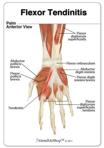 Extensor Tendonitis