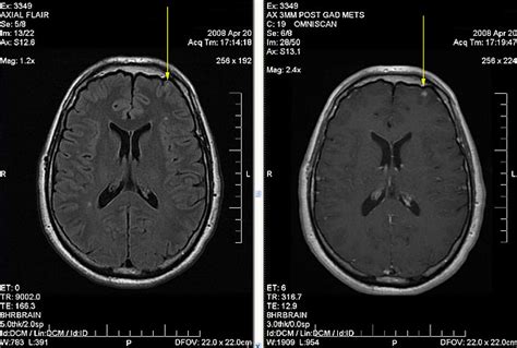 Melanoma with Brain Metastases - Medicor Cancer