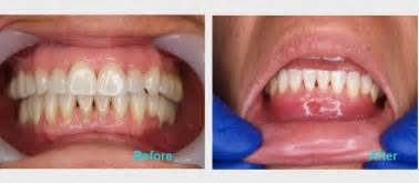 Gum Recession Brentwood |Gum Treatment| Brentwood Family Dental