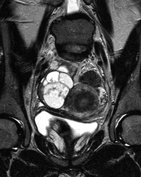 MR Imaging of the Sonographically Indeterminate Adnexal Mass | Radiology