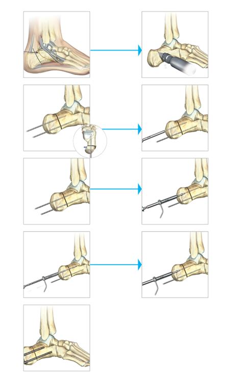 Calcaneal Osteotomy | Acutrak Advantage