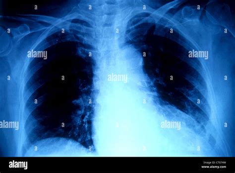 CARDIOMEGALY, X-RAY Stock Photo - Alamy