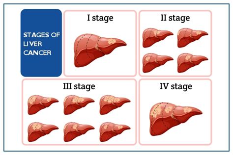 Liver Cancer: Symptoms, Signs, Causes & Treatment