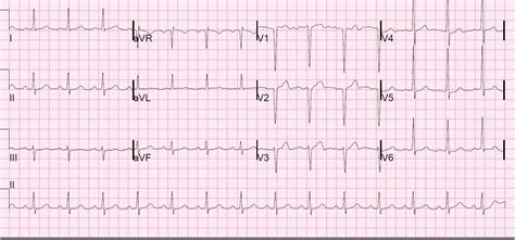 Dr. Smith's ECG Blog: Reversible T-wave inversion -- it reverses, then evolves, then reverses ...