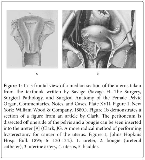 Cardinal Ligament Uterus Anatomy