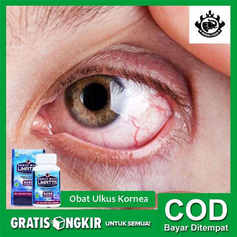 Jual Obat Luka pada Kornea Mata, Ulkus Kornea, Peradangan pada Mata ...