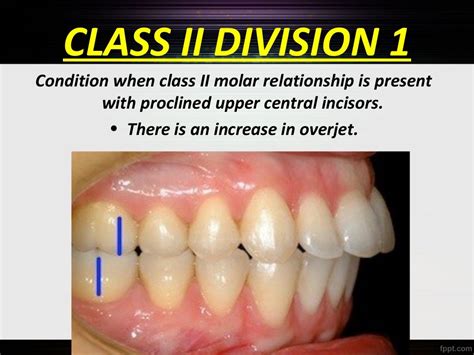 Classification of malocclusion