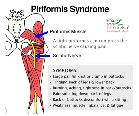 Piriformis Syndrome Massage Treatment - GG Physio