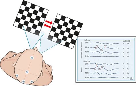 Evoked potential tests in clinical diagnosis | Tidsskrift for Den norske legeforening