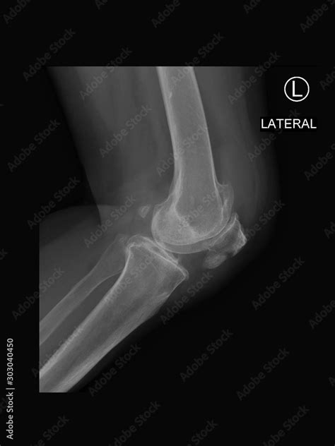 Film x-ray knee radiograph show fracture patella ( kneecap broken ...