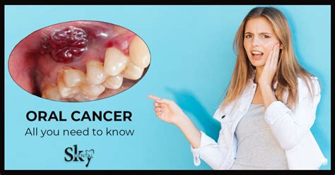 Oral Cancer - All you need to know! - sky dental care hospital