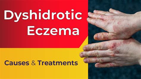Dyshidrotic Eczema Nails