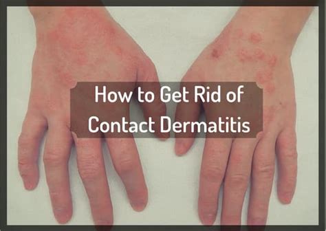 How I Got Rid of Itchy Contact Dermatitis the Natural Way - RemedyGrove