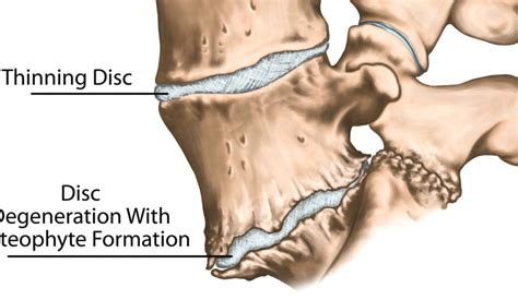 Bone Spurs of the Spine – What Causes Them and How Can They Be Treated ...