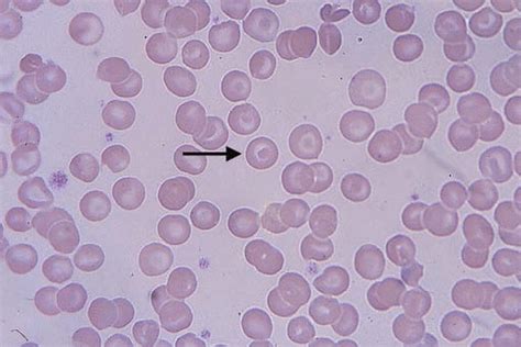 Target Cells Thalassemia