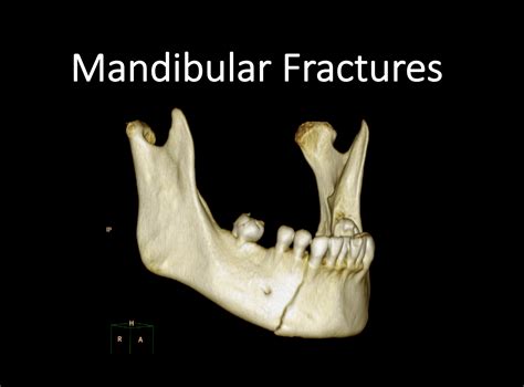 Mandible Fracture Treatment