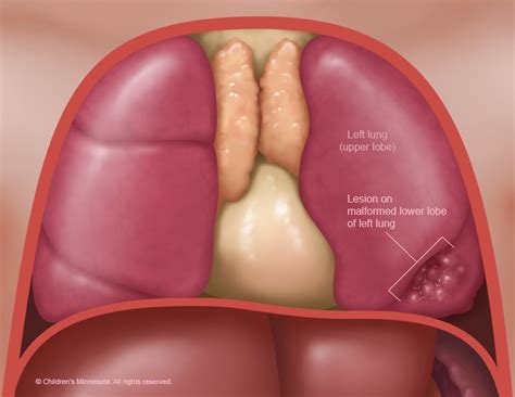 Congenital Lung Abnormalities | Children's Minnesota