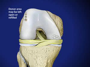 OATS Cartilage Repair Surgery in Omaha, Ne