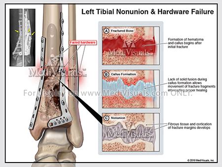 Bone Remodeling: Fracture Healing Process and Associated Complications ...