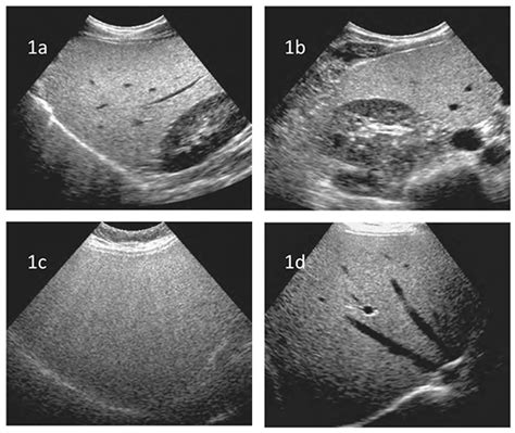 Ultrasound Images Of Fatty Liver