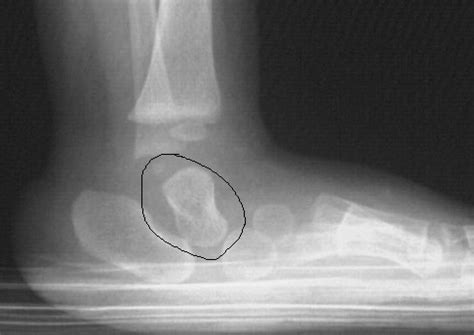 What does congenital vertical talus deformity mean? | Podiatry FAQ's