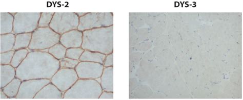 Figure 1 from Exercise induced cramps and myoglobinuria in dystrophinopathy - A report of three ...