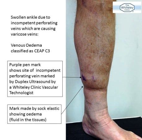 Swollen ankle from incompetent perforator veins - The Whiteley Clinic