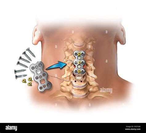 List 97+ Images C4 5 And C5 6 Anterior Cervical Discectomy And Fusion ...