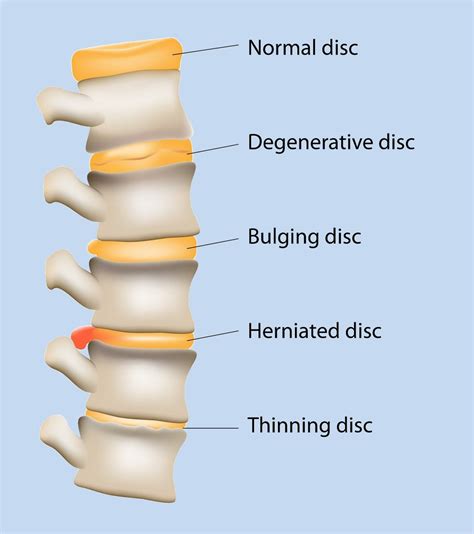 Degenerative Disc Disease - Kalra Brain & Spine