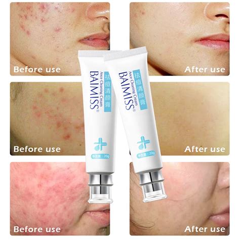 BAIMISS Acne Cleaning Cream Skin Care Remove Repair Comedone Pimple Acne Quickly Face Acne Cream ...