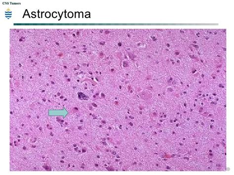 Pathology of CNS Tumors