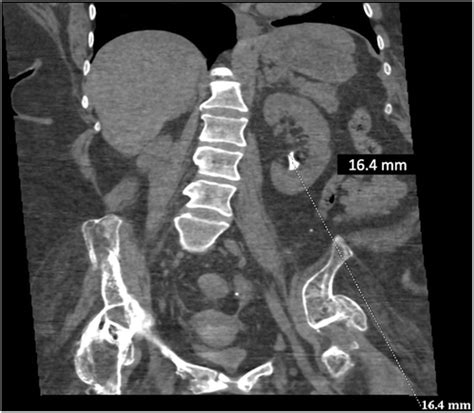 Surgical Clips Migration up to Renal Collecting System from Ileal Conduit Postcystectomy ...