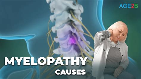 Myelopathy | Causes - AGE2B