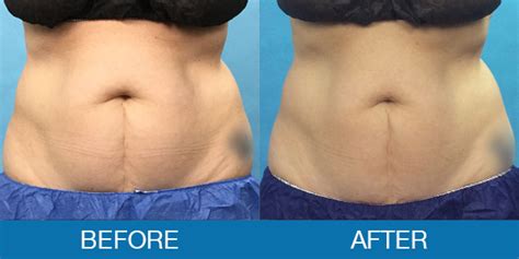 CoolSculpting® Before and After - New Hampshire, Dr. Miller - AestheticBodyShaping.com