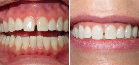 Clear Aligner Therapy Before & After Photos | Louisville Dentist