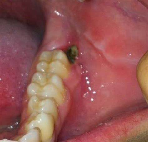 Wisdom Tooth Infection - Symptoms, Causes, Treatment, Pictures