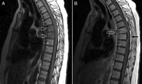 (A) Non-contrast T1 magnetic resonance imaging (MRI) of thoracic spine...