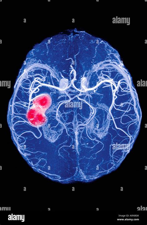 x ray of brain showing hemorrhage blood clot brain attack Stock Photo - Alamy