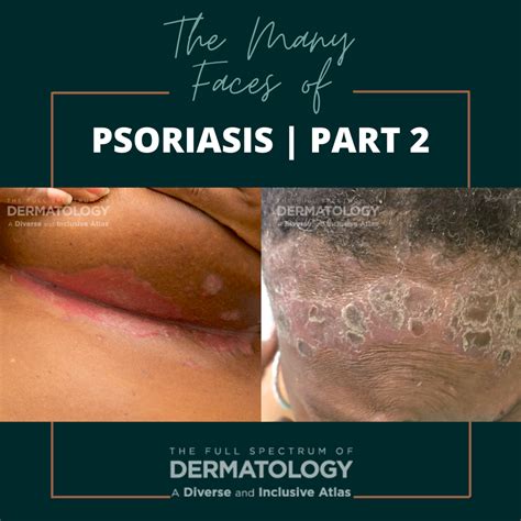 The Many Faces of Psoriasis | Part 2 - Next Steps in Dermatology