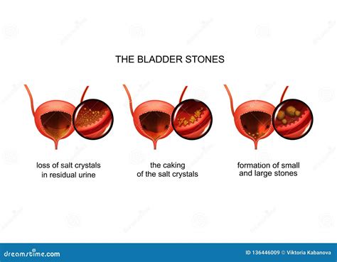 Formation of Bladder Stones Stock Vector - Illustration of medicine, carcinoma: 136446009