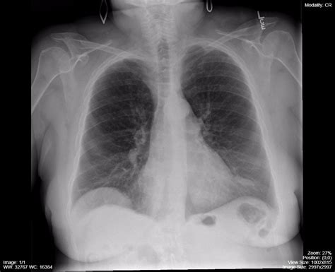 Atelectasis – Undergraduate Diagnostic Imaging Fundamentals