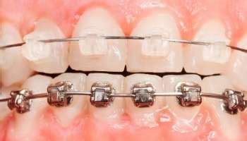 Clear Braces | Dental Associates