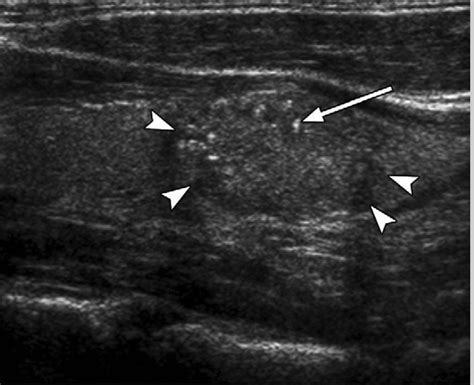 Thyroid Nodules - Causes, Symptoms, Ultrasound, Surgery